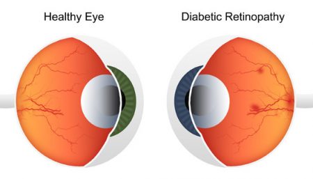Diabetic Retinopathy